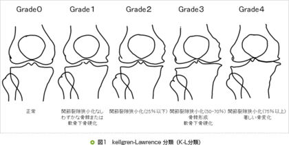 変形性膝関節症の方が家族にいる方へ
